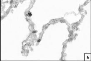 Marked alveolar apoptosis/proliferation