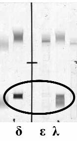 CSE REPORT C Figura 1 Caso 1 (settembre 2009): ) tracciato elettroforetico delle sieroproteine; la freccia indica la sospetta componente monoclonale; ) siero, tipizzazione mediante immunofissazione