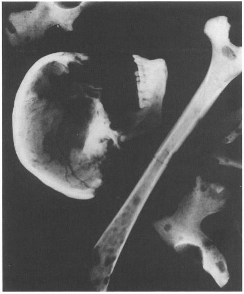Radiografia che mostra lesioni osteolitiche punched-out evidenti in tutte le ossa 3.