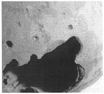 L immagine sopra a sinistra rappresenta una lesione osteolitica di un corpo vertebrale suggestiva di Mieloma Multiplo, la lesione infatti non mostra reazione osteoblastica.