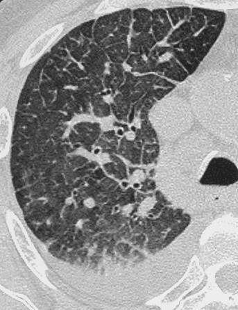 Edema interstiziale segni TCAR Edema cardiogeno ispessimento dell interstizio peribroncovascolare