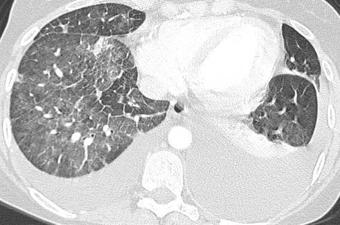 Edema interstiziale segni TCAR Edema cardiogeno aree a