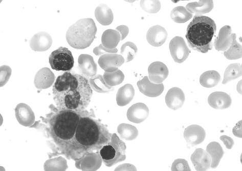 In basso a sinistra, un proeritroblasto con cromatica megaloblastoide. b) Displasia plurilineare.