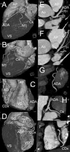 F. Cademartiri et al: Angiografia coronarica non invasiva con Tomografia Computerizzata spirale multistrato 293 Fig. 5. Esempio di placca aterosclerotica soft a livello della coronaria sinistra.