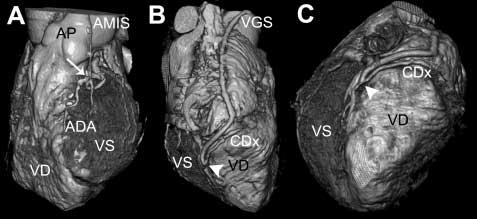 294 F. Cademartiri et al: Angiografia coronarica non invasiva con Tomografia Computerizzata spirale multistrato Fig. 6. Esempio di follow-up di bypass aorto-coronarico.