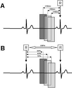 The prospective modulation of the X-ray exposure through the synchronization of the tube current with the ECG.
