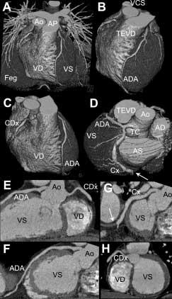 288 F. Cademartiri et al: Angiografia coronarica non invasiva con Tomografia Computerizzata spirale multistrato Fig. 4. Esempio di scansione coronarica con apparecchiatura TC multistrato a 16 canali.