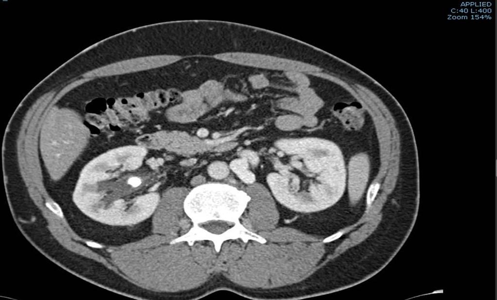 Trombosi idiopatica? Escluse cause trombofiliche congenite Screenig trombofilia negativo. Esami ematochimi non significativi.