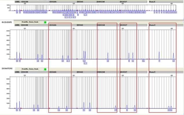 Identificazione dei loci informativi L identificazione dei loci informativi viene eseguita su campioni di R e D pretrapianto.