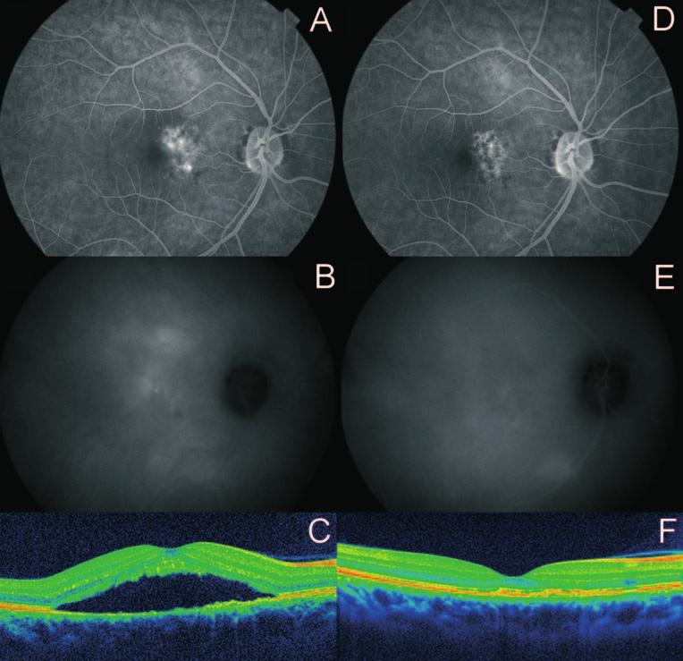 32 Very minimal fluence photodynamic therapy for persitent central serous chorioretinopathy Fig. 1 Fig.