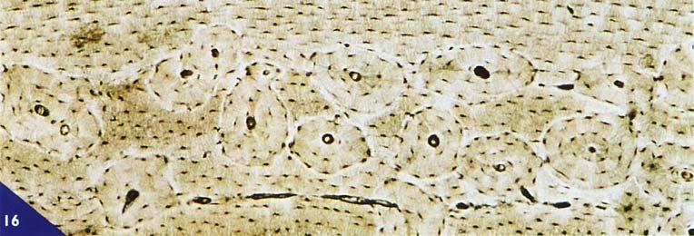 Nell'accrescimento diametrale delle ossa il riassorbimento è tanto attivo quanto la formazione di nuovo tessuto.