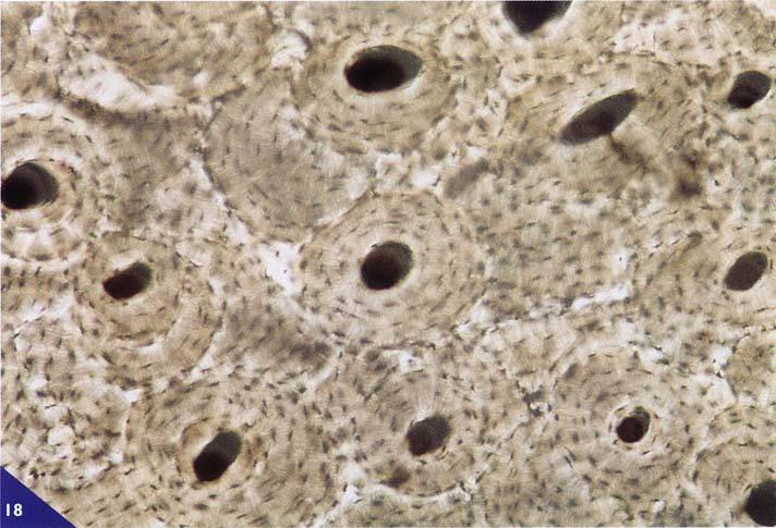 Nel rimaneggiamento strutturale la superficie, dove ha avuto termine l attività erosiva degli osteoclasti e dove è cominciata la nuova deposizione ossea, si identifica in sezione per la presenza