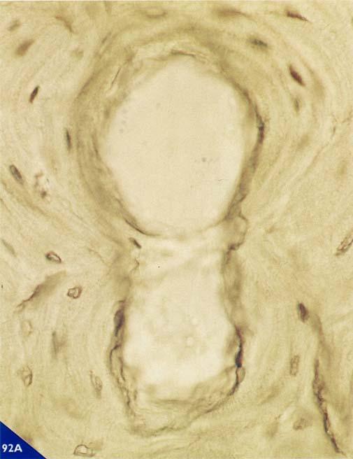 Gli osteoclasti, riassorbendo la superficie ossea, producono cavità dai bordi irregolari e l intera superficie di erosione assume un aspetto dentellato.