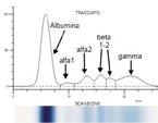 ASSOCIAZIONE IMMUNODEFICIENZE ASSOCIAZIONE PRIMITIVE Diagnosi Prima di porre diagnosi di ICV vanno escluse tutte le altre cause di ipogammaglobulinemia (ridotto numero di anticorpi circolanti).