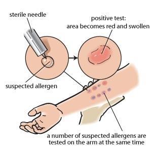 Diagnosi di Allergia Alimentare Sospetto clinico Prick test/prick by prick Dosaggio IgE sieriche