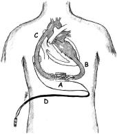 T Colombo et al - Assistenza ventricolare nell insufficienza cardiaca avanzata mi a flusso pulsatile; la differenza sostanziale consiste nelle dimensioni della tasca addominale, che, data la ridotta