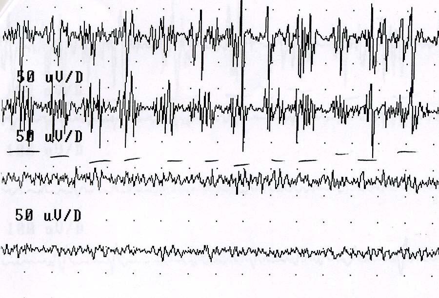 MATERIALI E METODI (5) POLIMIOGRAFIA Pattern tremore : attività tremorigena con frequenza tra