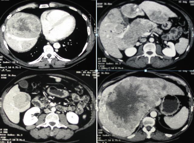 Fig. 1: metastasi epatiche da tumore neuroendocrino del retto. Settembre 2005: massa epatica Ø 20 cm, no trombosi portale Febbraio 2006 OLT.