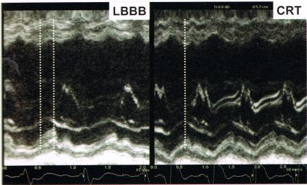 RAZIONALE DELLA TERAPIA DI RESINCRONIZZAZIONE CARDIACA Le indicazioni alla CRT si basano sulla valutazione clinica del paziente, sul riscontro di parametri di disfunzione ventricolare (FE, dtd) e di