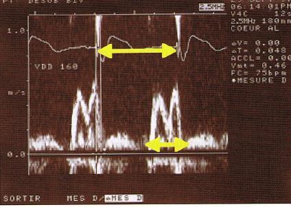 agevolmente con ecocardiografia standard. Questo indice è forse meno specifico ma certamente più sensibile del BAV di I grado.