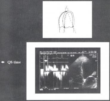 Tanto più largo è il QRS, tanto maggiore risulta tale indice, ma la correlazione tra questi due parametri non è così stretta da poter predire il ritardo di contrazione del ventricolo sinistro in base