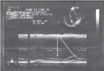 Anche in questo caso l ecocardiografia ci consente di valutarne l entità con numerosi indici.