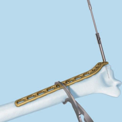 Tecnica chirurgica Misurare la lunghezza della vite spostando il lato assottigliato del misuratore di profondità sul filo di Kirschner in