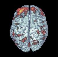 Dopaminergic Abnormalities in Schizophrenia Schizophrenia appears to be associated with numerous abnormalities in the central dopamine system: Harrison PJ (1999) Brain