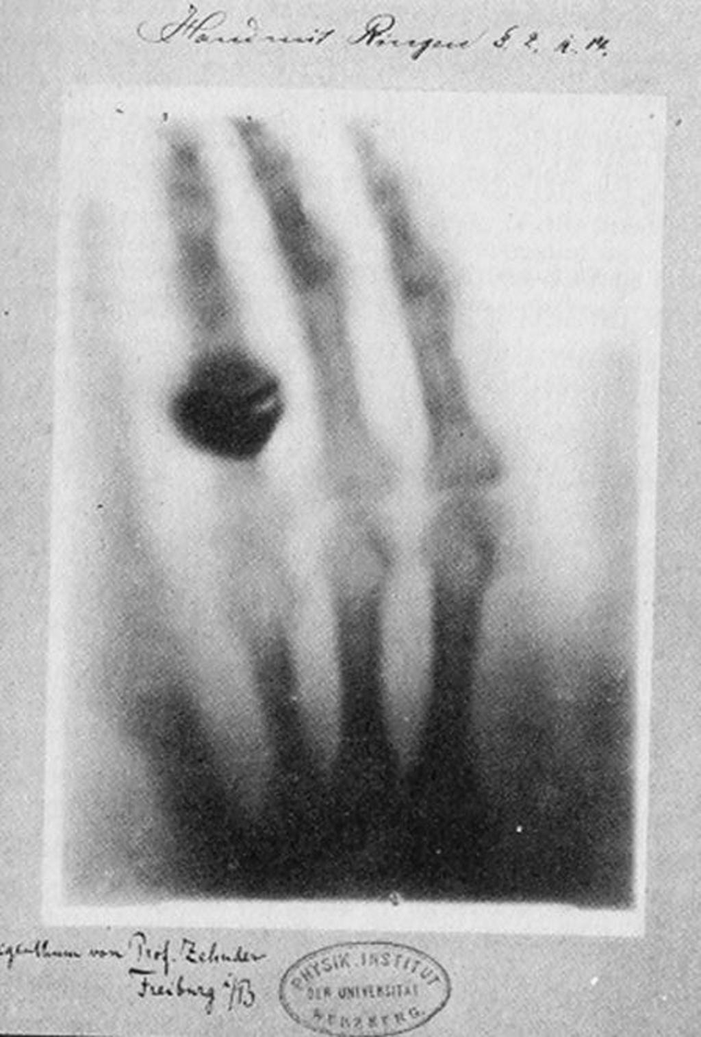 1. Storia Figura 1.1: La radiografia della mano della moglie di W. C. Röntgen: è la prima immagine a raggi X della storia (a sinistra).