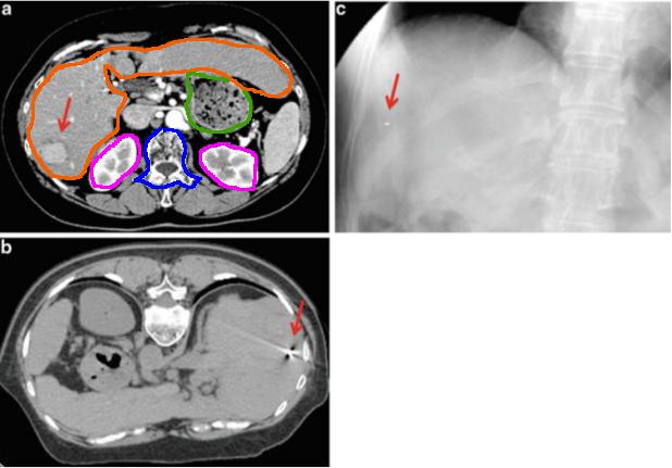 5.2. Patologie attualmente trattate 5. Aspetto medico Figura 5.7: Immagini di un paziente con HCC 5.5 cm nel settore posteriore destro del fegato. (a) Immagine CT prima del trattamento.