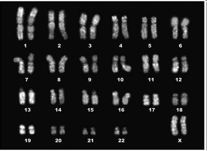 STABILITÀ GENETICA Analisi del Cariotipo su diverse metafasi Comparare le cellule del paziente prima e dopo la manipolazione in
