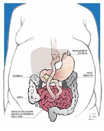 BY PASS GASTRICO (GBP) Capacità gastrica = 60 ml La tasca gastrica non comunica con il resto dello stomaco ed è collegata all'intestino tenue (anastomosi gastro-digiunale ) la maggior parte