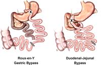 HYP.3 Foregut hypothesis Escludendo il duodeno dal contatto con i nutrienti si ottiene