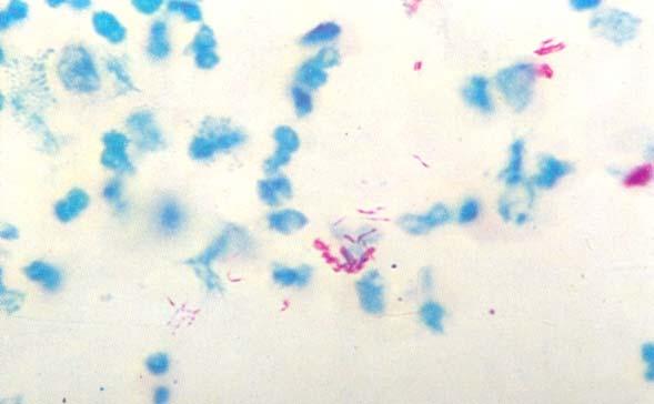 Con la colorazione di Ziehl Neelsen i micobatteri appaiono rossi e tutto il resto del materiale strisciato (cellule, muco, altri batteri) si colora in blu La resistenza