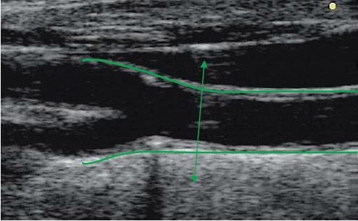 Mannheim Carotid Intima-Media