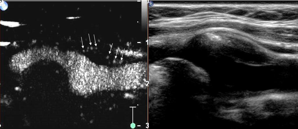 Contrast-enhanced ultrasound imaging of the vasa vasorum: from