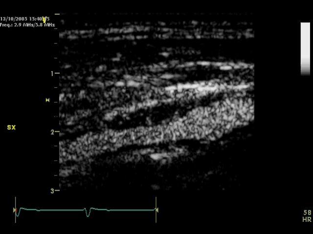 Hypoechoic Carotid Plaque With Extensive (Grade 2)