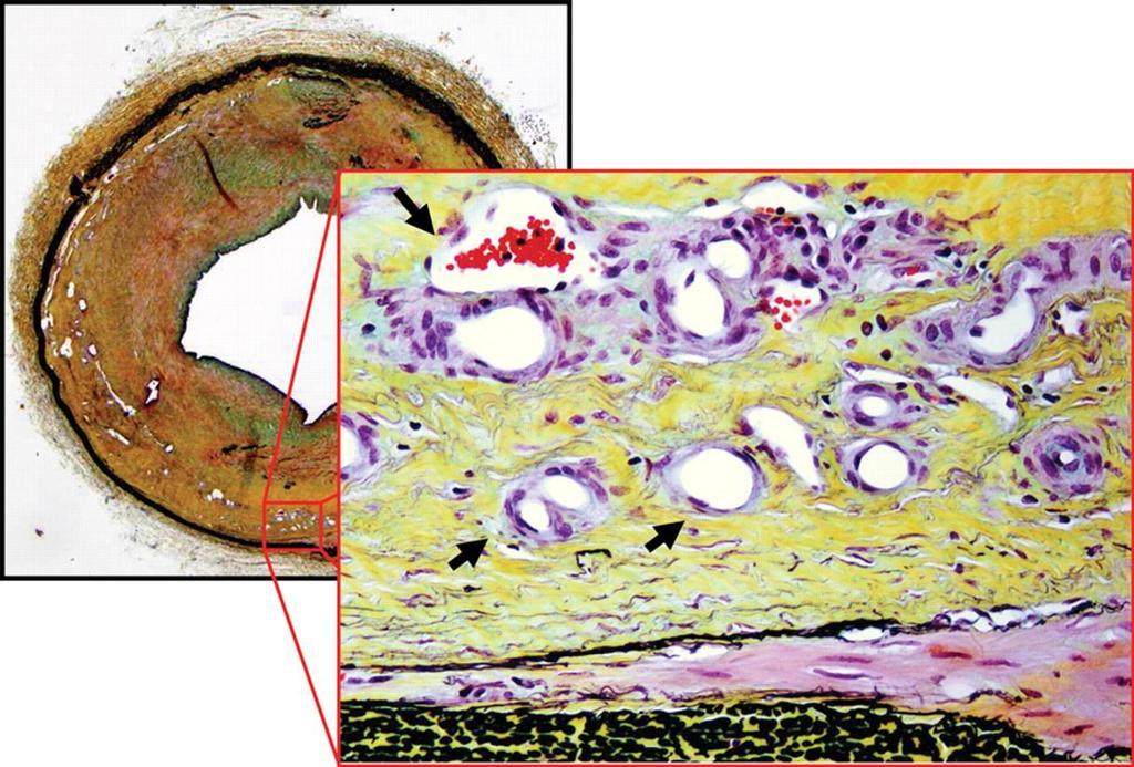 Histology sample demonstrating neovascularization (vasa vasorum indicated by the black arrows) in the tunica media (Movat pentachrome staining), after 43 weeks follow-up. Schinkel A F et al.