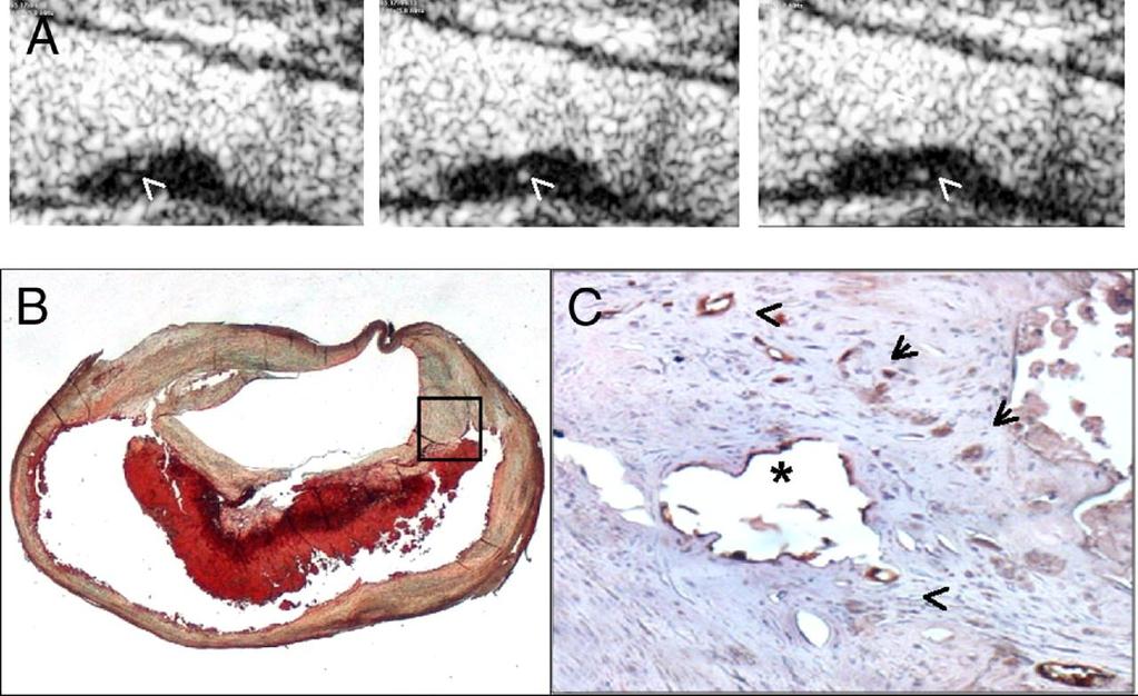 Plaque With Grade 2 Contrast-Agent Enhancement Showing Abundant Neovascularization at Histology Coli, S. et al.