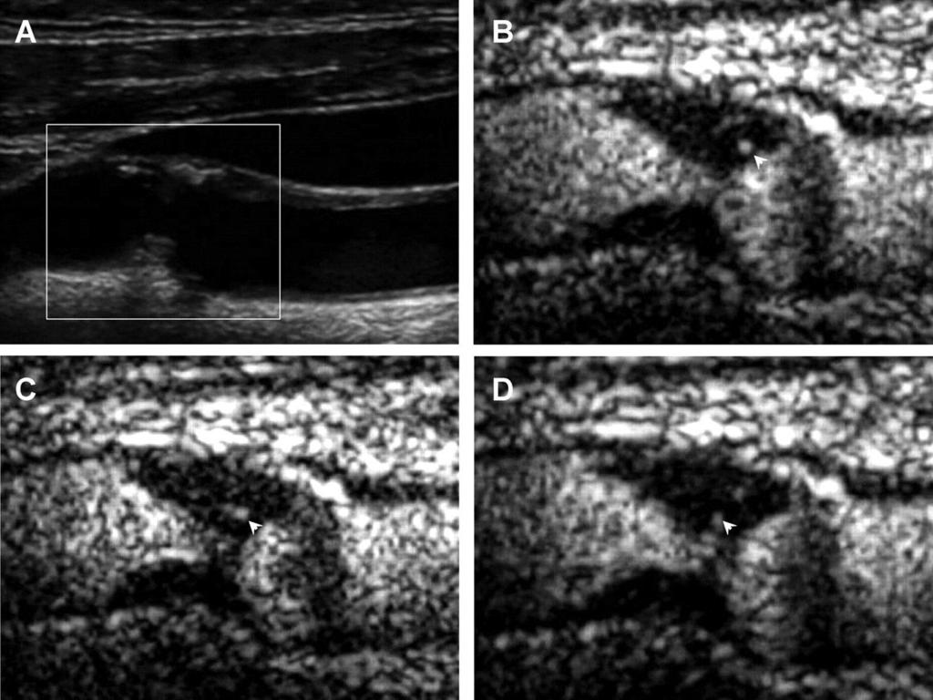 neovascularization grade 2 on