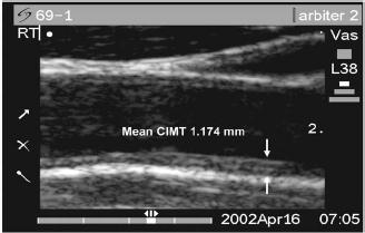 Significant Carotid IMT
