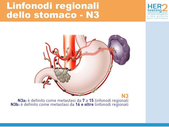 Presenza di metastasi a distanza (parametro M) La classificazione M indica la presenza di siti metastatici che vanno confermati istologicamente.