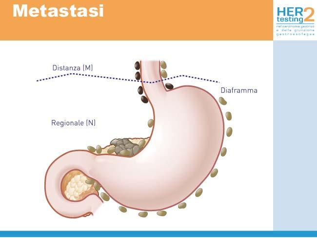 Parametro R Il parametro R identifica l assenza o la presenza di tumore residuo dopo il trattamento chirurgico.