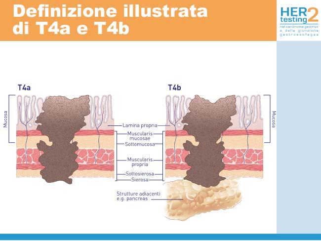 Interessamento dei linfonodi loco-regionali (parametro N) La classificazione N tiene conto della valutazione dei linfonodi regionali; prevede la loro rimozione e l esame istologico di tutti i