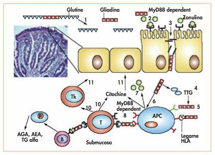 Gli attivatori chiave della malattia celiaca sono i PEPTIDI IMMUNOGENICI specifici della gliadina (contenenti glutammina) resistenti alla digestione enzimatica pancreatica e gastrica che riescono a