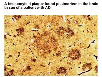 di -amiloide Neuroni contenenti grovigli neurofibrillari Una