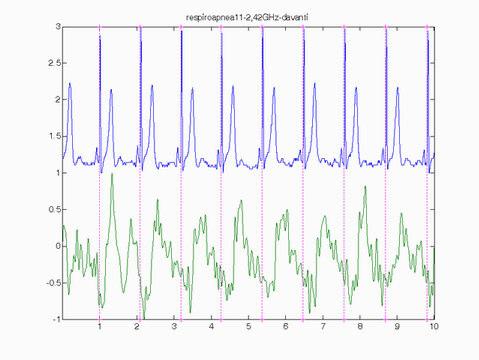 Figura 4 - Ciclo medio ECG (sopra) e corrispondente onda media del segnale radar filtrato (blu) con range di variabilita +/- una deviazione standard (rosso).