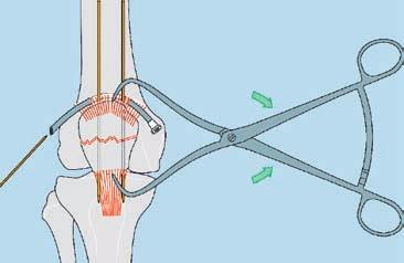 Tecnica rapida d impianto di fili di cerchiaggio 2 Inserimento dei fili di cerchiaggio 1 Introdurre i fili di cerchiaggio attraverso le strutture