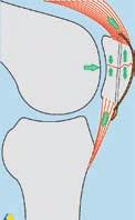 La vista laterale dimostra il principio della banda di tensione, che flettendo il ginocchio converte le forze tensili in forze compressive