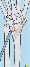 La sezione seguente illustra passo-passo la riduzione percutanea e la fissazione con filo di Kirschner per il trattamento di una frattura del radio distale